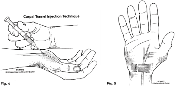 carpal tunnel injections diagram