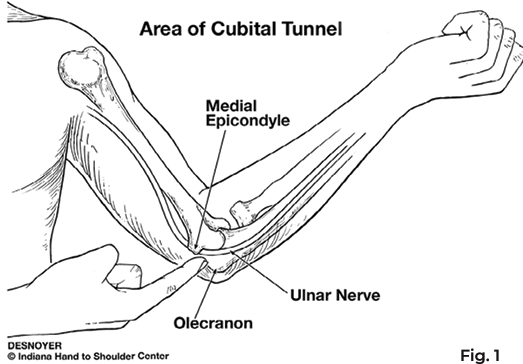 Cubital Tunnel Syndrome, Patient Education