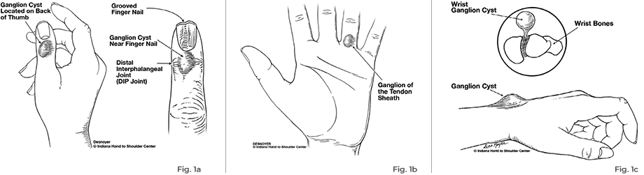 ganglion cyst diagram