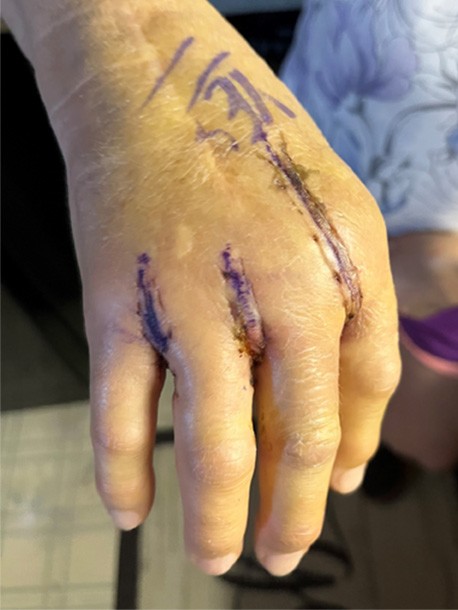 scarred and stitched hand immediately following surgery