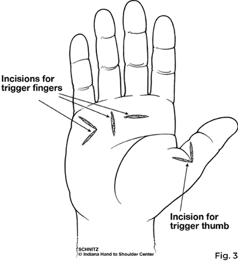 What Is Trigger Finger? | Patient Education | IHTSC