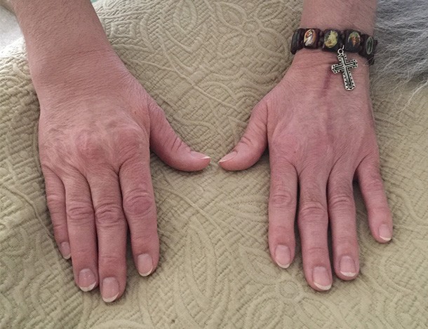 patients hands following multiple wrist surgeries