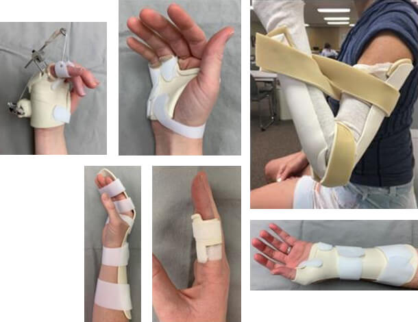 patient hands and arms in custom orthoses