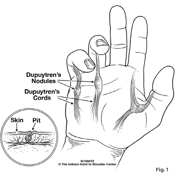 dupuytren diagram