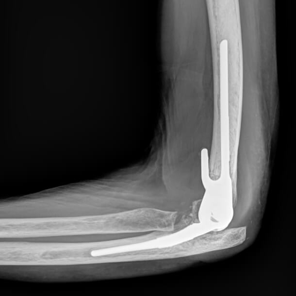 elbow replacement x-ray of patient, Judy, after surgery