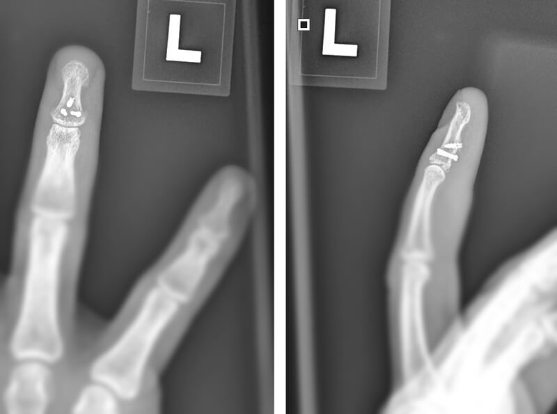 X-ray images of jersey finger patient.