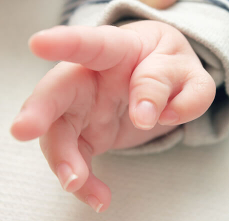 infant hand with six fingers on one hand