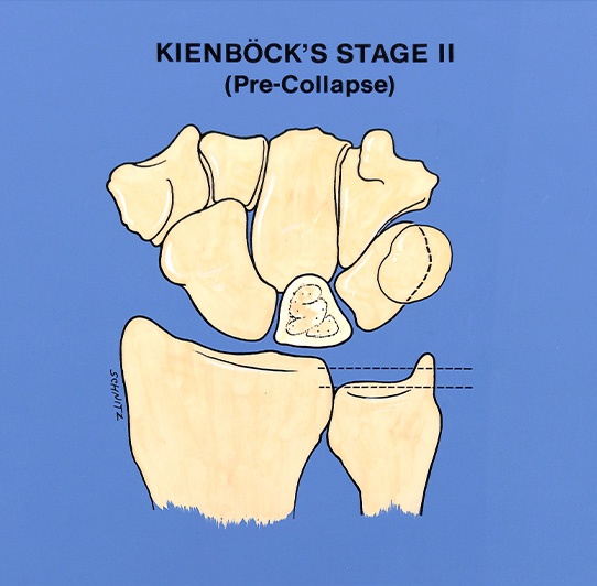 kienböck’s diseases stage 2 illustration