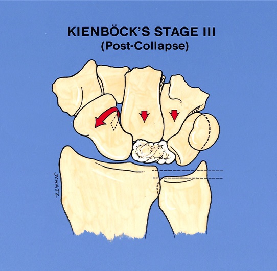 kienböck’s diseases stage 3 illustration