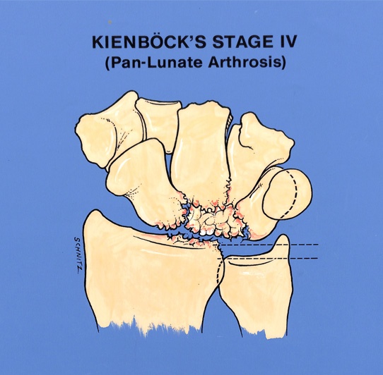 kienböck’s diseases stage 4 illustration