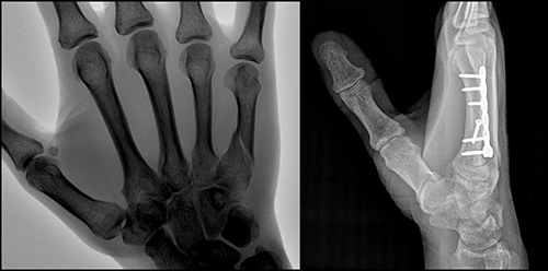 Hand X-Ray