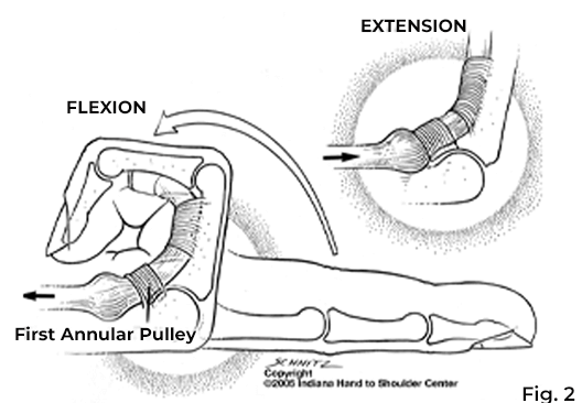 “Triggering of the affected finger is due to flexor tendon swelling at the first annular pulley